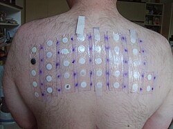 Patch test