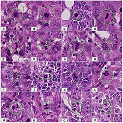 Mitosis appearances in breast cancer