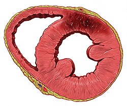 Cross section showing anterior left ventricle wall infarction