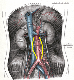 A plate from Gray's Anatomy with yellow lines depicting the most common infrarenal location of the AAA