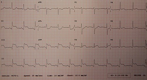 A 12-lead ECG showing an inferior STEMI due to reduced perfusion through the right coronary artery. Elevation of the ST segment can be seen in leads II, III and aVF.