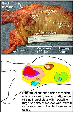 Longitudinally opened freshly resected colon segment showing a cancer and four polyps, plus a schematic diagram indicating a likely field defect (a region of tissue that precedes and predisposes to the development of cancer) in this colon segment. The diagram indicates sub-clones and sub-sub-clones that were precursors to the tumors.
