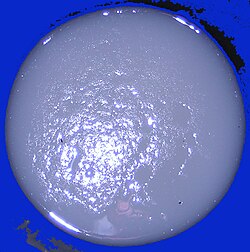 Typical cholera diarrhea that looks like "rice water"