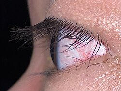 A refractive cornea type eye of a human. The cornea is the clear domed part covering the anterior chamber of the eye.