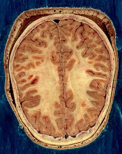 Horizontal section of the head of an adult female human, showing skin, skull, and brain with gray matter (brown in this image) and underlying white matter