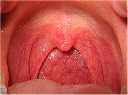 Pharyngitis is the painful swelling of the throat. The oropharynx shown here is very inflamed and red.