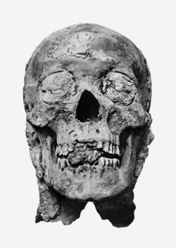 Mummified head of Amenhotep III following unwrapping