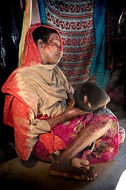 Rohingya woman, covered in bruises and burns; Tatmadaw troops dragged her into a house, raped her, and attempted to burn the house down whilst locking her inside.