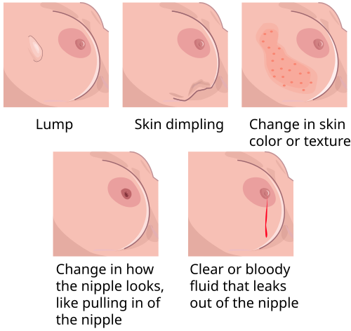 Cartoons of breasts with a lump, skin dimpling, red fluid leaking from the nipple, or changes in the appearance of the skin or nipple