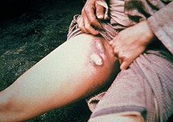 Swollen inguinal lymph glands on a person infected with the bubonic plague. The swollen lymph glands are termed buboes from the Greek word for groin, swollen gland: bubo.