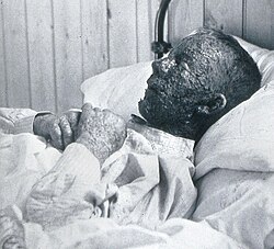 Malignant hemorrhagic smallpox in a baker during an 1896 epidemic in Gloucester, England. Died 8 days after admission.