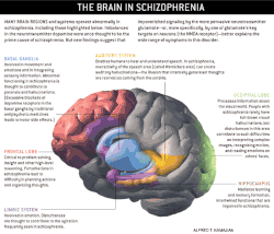 Diagram of the brain in schizophrenia