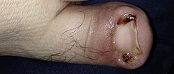 Infection of an ingrown toenail; there is pus (yellow) and resultant inflammation (redness and swelling around the nail).