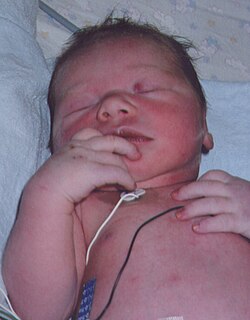 A baby with a heart condition. Note purple nailbeds.