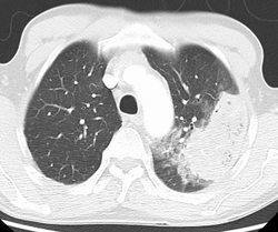 Cavitating pneumonia due to MRSA as seen on a CT scan