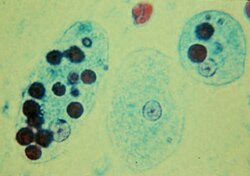 Trophozoites of Entamoeba histolytica with ingested erythrocytes