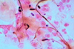 Candida albicans visualized by Gram stain and microscopy. Note the hyphae and chlamydospores, which are 2–4 μm in diameter.