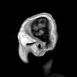An MRI of a human head showing benign familial macrocephaly (head circumference > 60 cm)