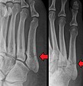 Example of Robert Jones' Jones fracture