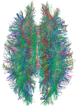 MRI diffusion tensor imaging of white matter tracts