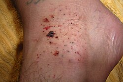 Sea urchin injury on the top side of the foot. This injury resulted in some skin staining from the natural purple-black dye of the urchin.