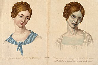 A young woman of Vienna who died of cholera, depicted when healthy and four hours before death, January 1831