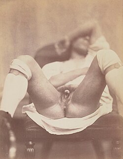 1860 photograph by Nadar of a person displaying ambiguous genitalia, one of a nine-part series. The series may be the earliest medical photographic documentation of an intersex person.[76]: 358