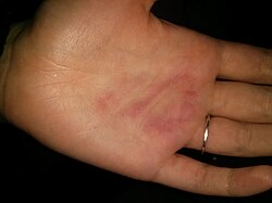 A hand after performing the salt and ice challenge