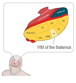 The ventrointermediate nucleus of the thalamus, the target nucleus for essential and Parkinson's tremor.