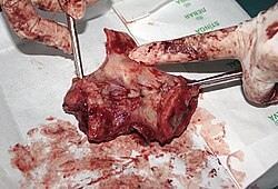 Removed larynx, containing cancerous tissue