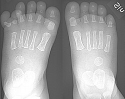 Right-sided duplication of the right little toe in an 8.5 months old male, with two toes (fifth and sixth) apparently forming joints with the fifth metatarsal bone, which is mildly broadened distally. The duplicated toes have almost normal growth. The fifth toe has mild varus angulation, and the sixth toe has substantial valgus angulation.