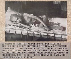 A victim of starvation in besieged Leningrad suffering from dystrophia in 1941.[195]
