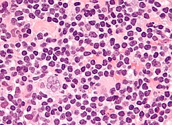 Micrograph showing a "popcorn cell", the Reed–Sternberg cell variant seen in nodular lymphocyte predominant Hodgkin lymphoma. H&E stain.