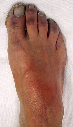 Peripheral cyanosis in an individual with peripheral vascular disease.