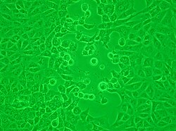 Cytopathic effect of herpes simplex virus. The infected cells have become round and balloon-like.