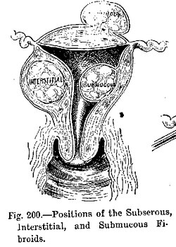 Diagram illustrating benign neoplasms, namely fibroids of the uterus