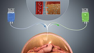 A depiction of peritoneal dialysis