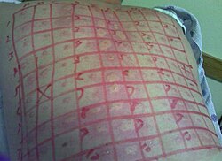 Skin testing on back