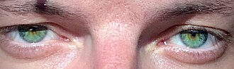 Miosis caused by high doses of opiates. The person also shows ptosis of both eyelids and an inattentive look at the camera, a sign of altered level of consciousness caused by the sedative effect of the drug.