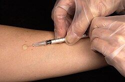 The Mantoux skin test consists of an injection of a small quantity of PPD tuberculin just below the skin on the forearm.
