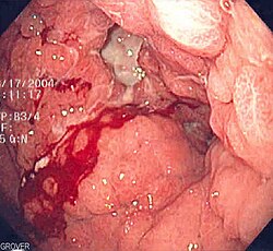 This stomach with Linitis plastica (Brinton's disease) can cause internal bleeding
